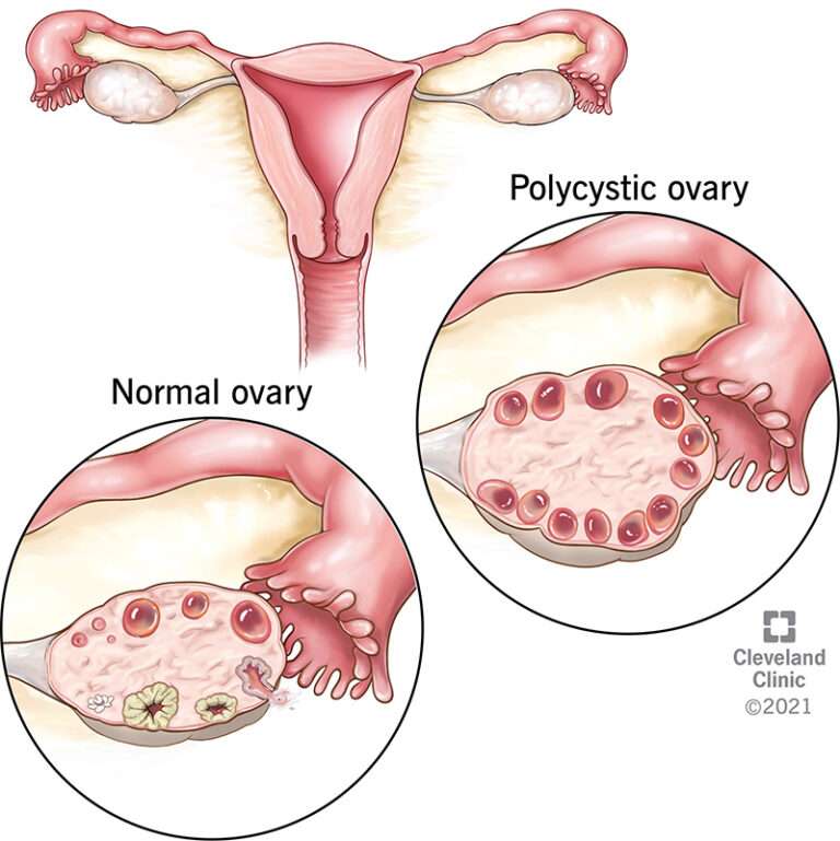 Understanding PCOS: Causes, Symptoms, and Treatment